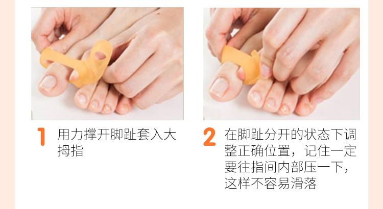 脚趾环矫正原理（脚趾环矫正的工作原理）
