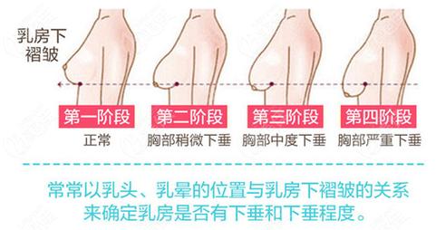 17岁胸下垂有什么办法能挺起来