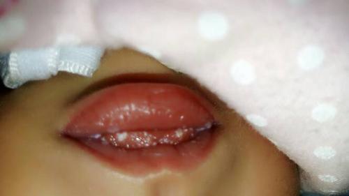 婴儿嘴巴里长白色的东西是什么