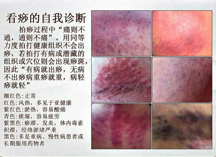 出痧的颜色代表什么（健康信息揭示）