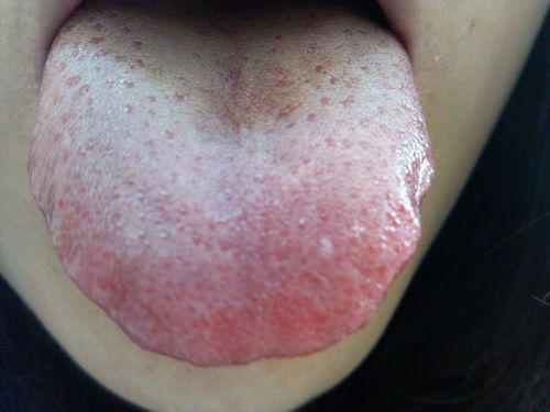 舌苔什么颜色正常（正常舌苔颜色是什么？）